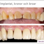 Implantat kronor och broar