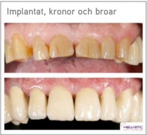 Implantat kronor och broar