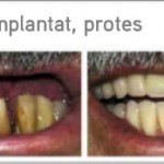 Sinus implantat protes