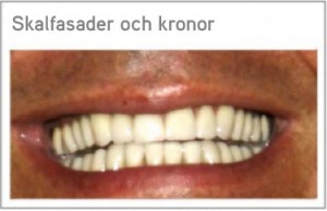 Skalfasader och kronor