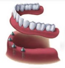 implant denture