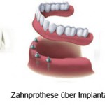 zahnimplantat im Ungarn