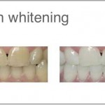 Helvetic-Clinics-teeth-whitening
