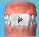dental-implant