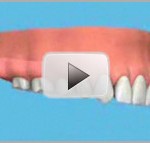 dental-implant-2