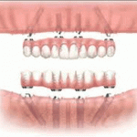 denture