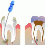 root-canal-treatment