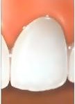 veneers-1