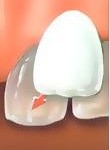 veneers