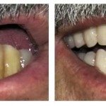 jacky-teeth-b4-after