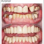 Kronor